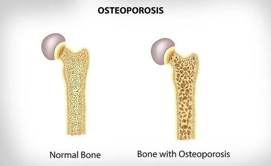 Are You at Risk for Osteoporosis? - Restivo Health & Wellness