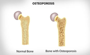  Lower Your Chances of Osteoporosis with These 3 Tips